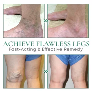 RENEW Varicose Veins Cream