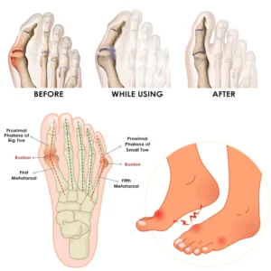 Ricpind AntiBunion VaricoseVein TourmalineSock