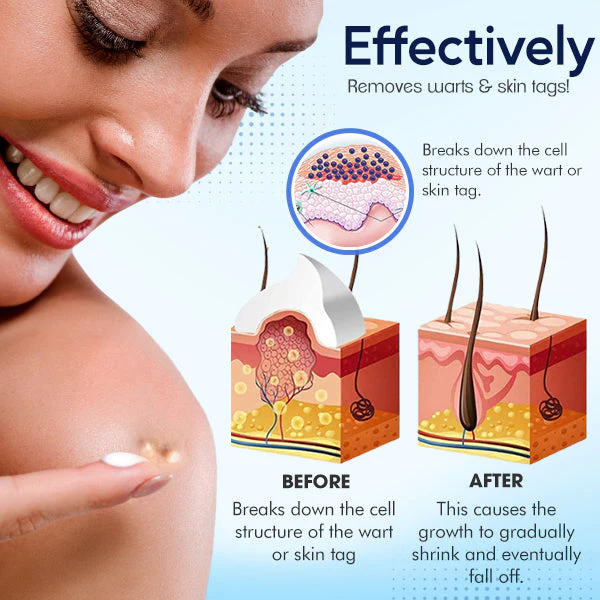 SkinPro™ Warts & Tag Remover Cream