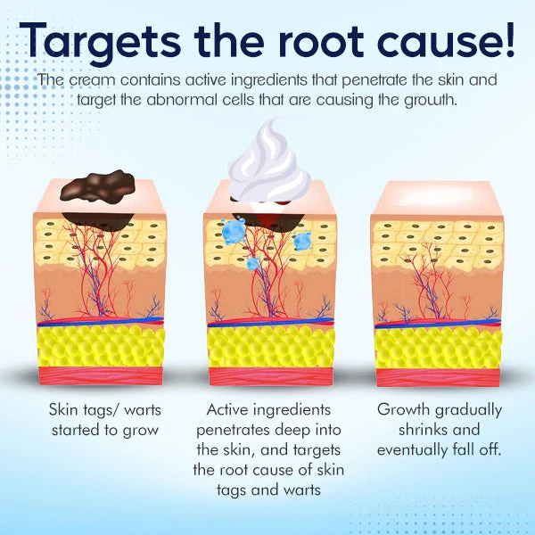 SkinPro™ Warts & Tag Remover Cream