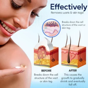 SkinPro™ Warts & Tags Remover Cream