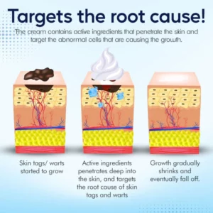 SkinPro™ Warts & Tags Remover Cream