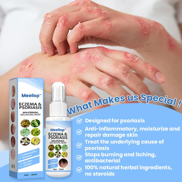 Suupilid™ Herbal Psoriasis Relief Spray