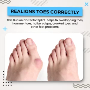 Suupillid™ 3D Instant Bunion Splint