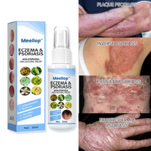 Suupillid™ Herbal Psoriasis Relief Spray