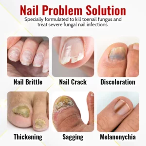 Suupillid™ Japanese NailRenew Onychomycosis Rapid Relief Oil