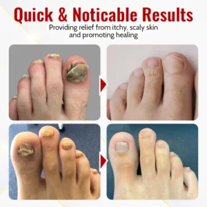 Suupillid™ Japanese NailRenew Onychomycosis Rapid Relief Oil