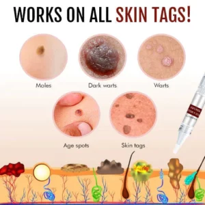 Suupillid™ Tags & Moles Remover