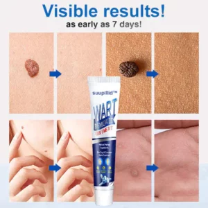 Suupillid™ Wart Removal Ointment