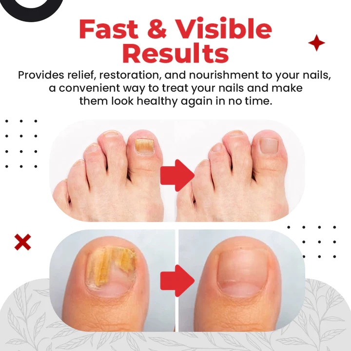 Dầu giảm nấm móng chân Pro™