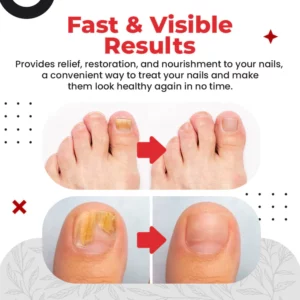 Toenail Pro™ Anti-Fungus Relief Oil
