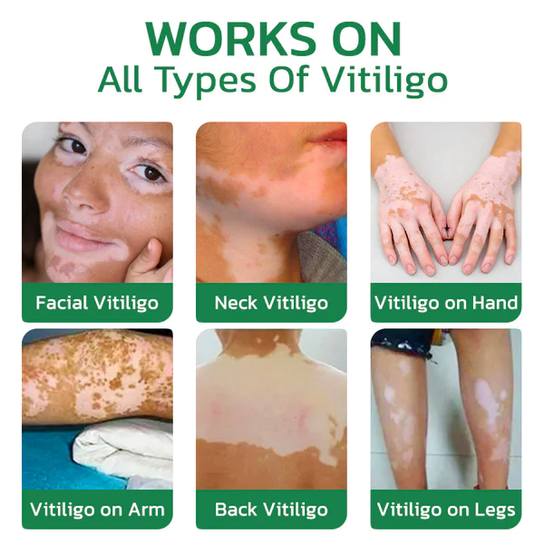 Treat Vitiligo Soothing Cream