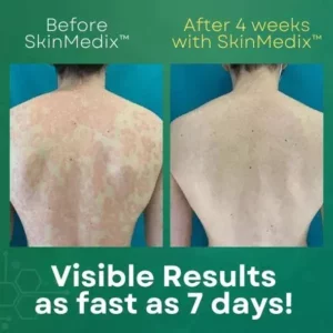 Universal Intense Psoriasis Skin Cream