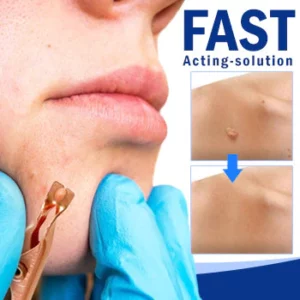 Wart Removal Sterile Clip