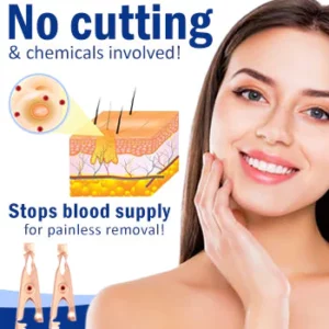 Wart Removal Sterile Clip