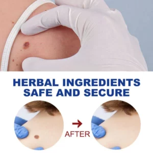 Wart removing pen