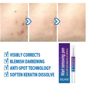 Wart removing pen
