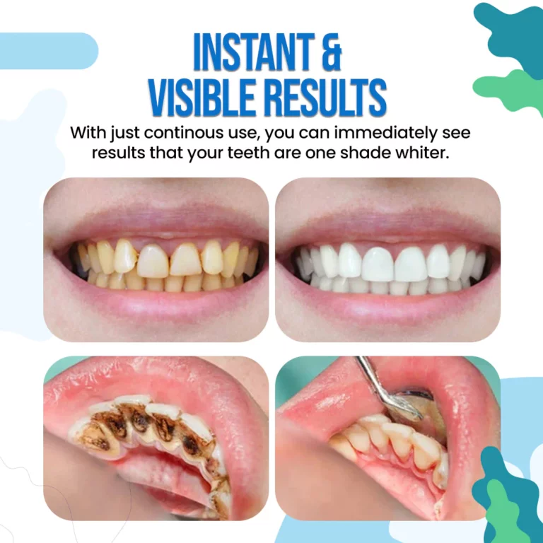WhiteOut™ boja za instant izbjeljivanje zuba