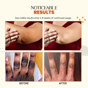 Zakdavi™ Acanthosis Nigricans Treatment Oil