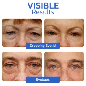 flysmus™ YoungEyes Awaken Peptid Lifting Augengel