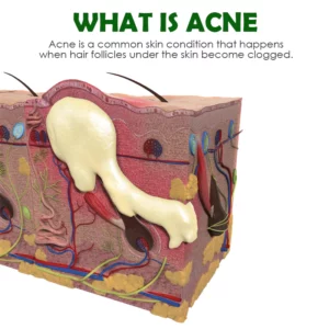 Alternative view of ATTDX AcneRemoval AloeVera OrganicGel