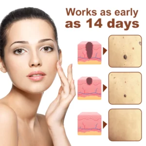 Alternative view of Biancat  MarkOut Birthmark Removal Serum