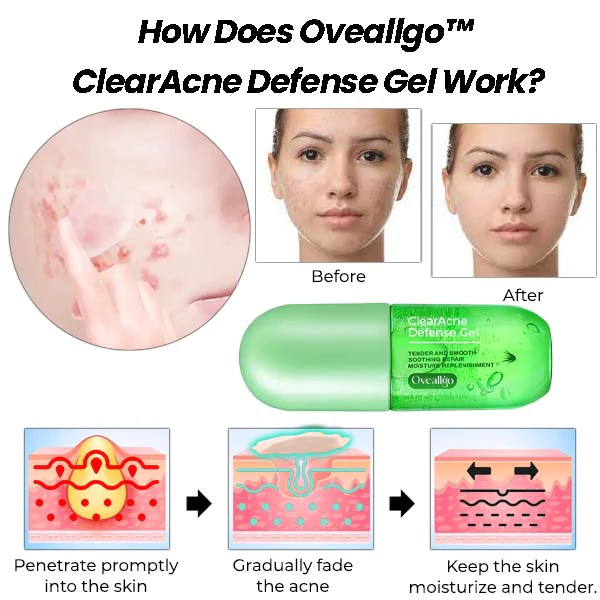 Oveallgo ClearAcne Defense Gel - Image 4