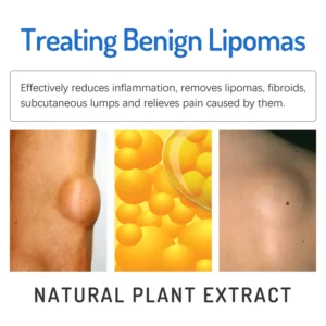 Alternative view of South Moon LumpFree Lipoma Removal Cream