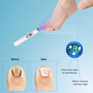 Alternative view of ARRIVALS Antifungal Laser Device Without Any Side Effects