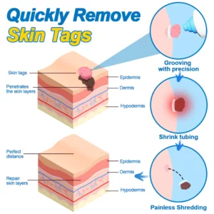 Alternative view of Biancat™ AcroGone Rapid Herbal Tag Removal Set