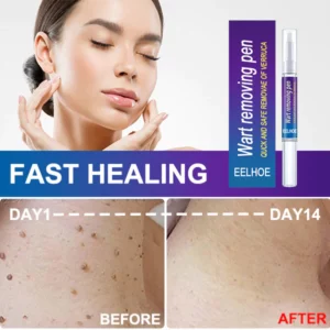 Alternative view of EELHOE ™ Skin Tag Remover