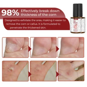 Alternative view of GFOUK™ Foot Corn Removal Extra Strengthen Gel