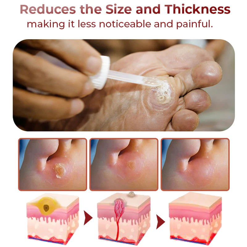 GFOUK™ Foot Corn Removal Extra Strengthen Gel - Image 3