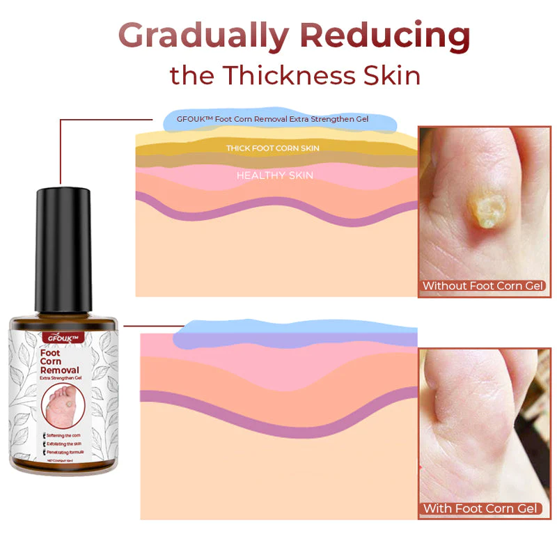 GFOUK™ Foot Corn Removal Extra Strengthen Gel - Image 4