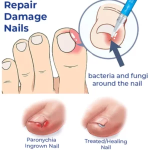 Alternative view of Oveallgo™ Removal Paronychia Gel