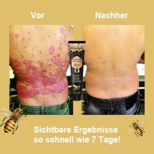 Alternative view of SunKissed New Zealand Bee Venom Psoriasis Treatment Gel