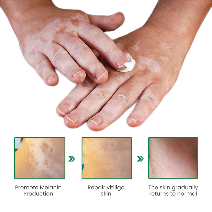 VitiligoFix Revitalize Elixir - Image 5