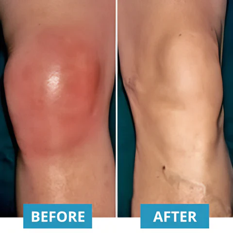 KTS® Infrared Laser Knee Pain Therapy Massager - Image 6