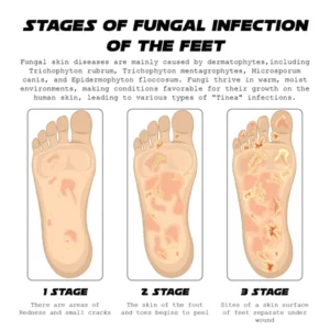 ATTDX AthletesFoot FungusRelief TreatmentSpray