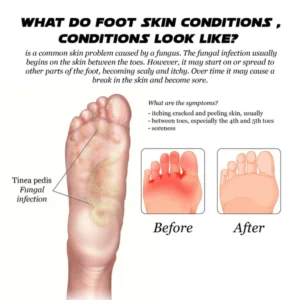 ATTDX AthletesFoot FungusRelief TreatmentSpray