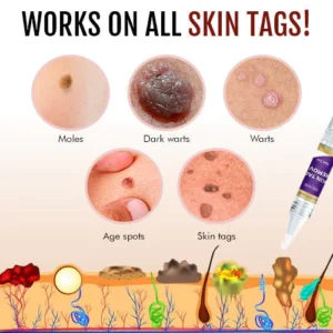 CCTM Tags & Moles Remover