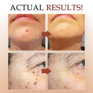 CCTM Tags & Moles Remover
