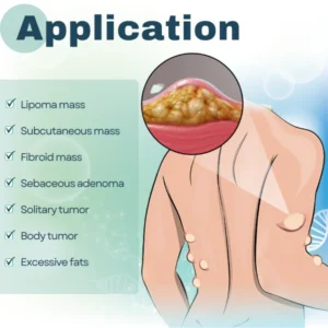 DermaFix™ Lipoma Removal Cream