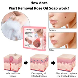 KK™ Wart Removal Rose Oil Soap
