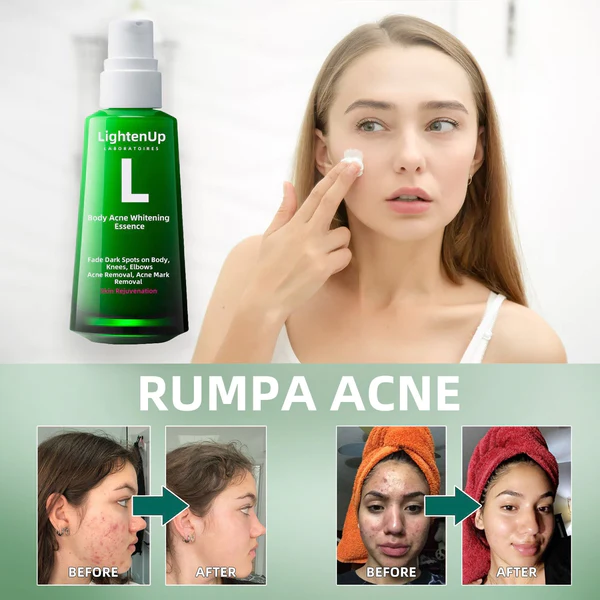 LightenUp™ Body Acne Serum