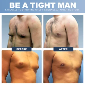 Luhaka™ GynoPatch - Advanced Gynecomastia Reduction Patch