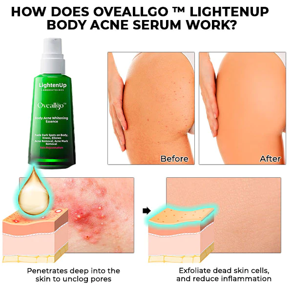 Oveallgo™ LightenUp Body Acne Serum