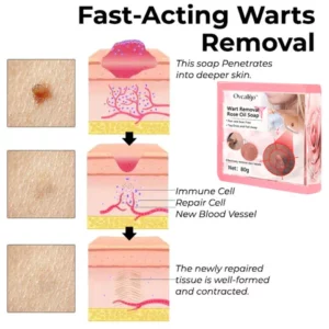 Oveallgo™ Wart Removal Rose Oil Soap