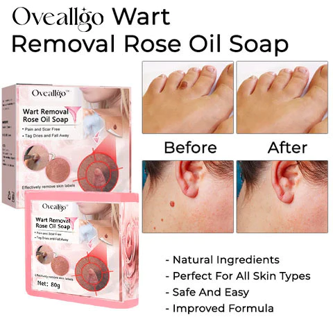 Oveallgo™ Wart Removal Rose Oil Soap