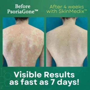 Alternative view of PsoriaGone™ Natural Herbaceous Plants Psoriasis Cream
